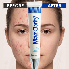 MazClarity Anti Acne Cream