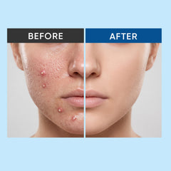 MazClarity Anti Acne Toner