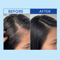 ZyroMAZ Anti Dandruff Shampoo