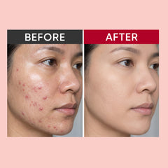 Acnes BAR